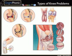 Types of Knee Problems