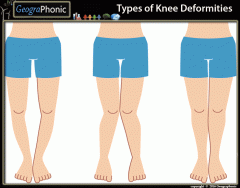 Types of knee Deformities