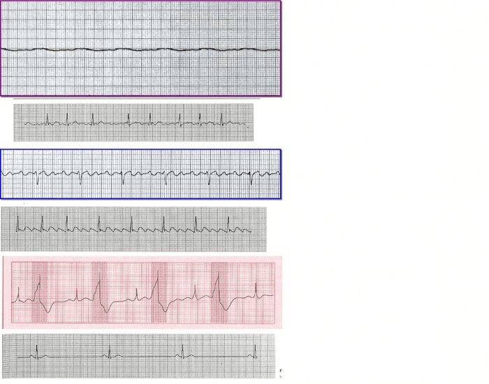 Michael recommends best of Ekg sample strip Porn tube 2020 Boy fuck milf in mini skirt