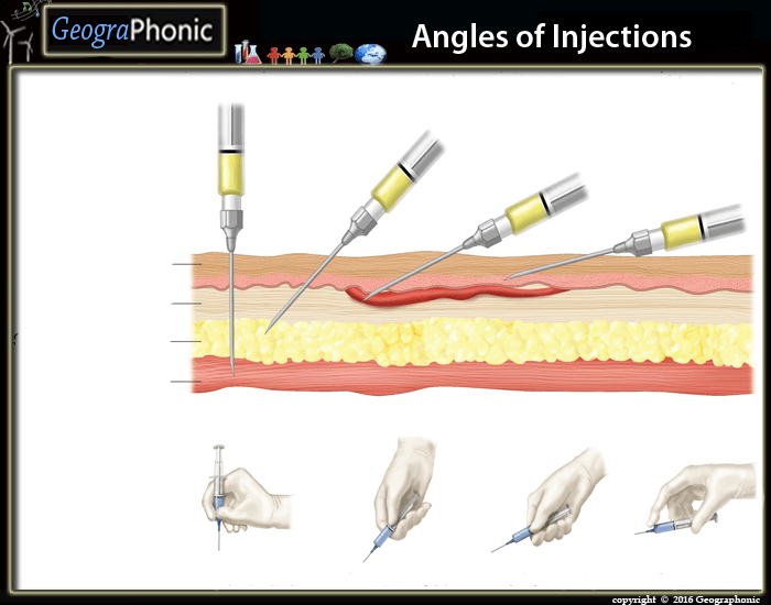 Angles of injections Quiz