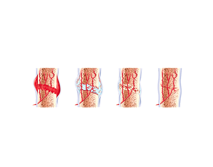 stages-of-healing-in-a-bone-fracture-quiz