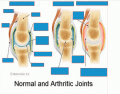 Normal vs. Arthritic jointz