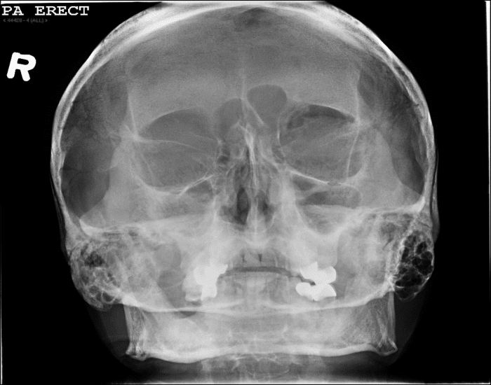 Waters Radiograph Method Modified Waters Radiograph Quiz