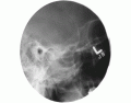 TMJ Radiograph - Axiolateral Projection (Schuller)