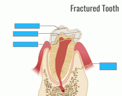 Tooth fracturez