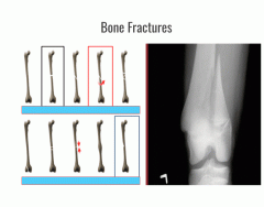 Bone fracturez