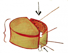 Basic Body of Vertebrae