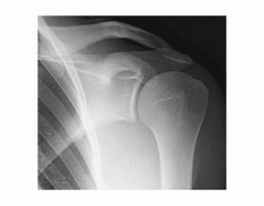 Grashey Shoulder X-Ray Anatomy