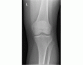 AP Knee X-Ray Anatomy