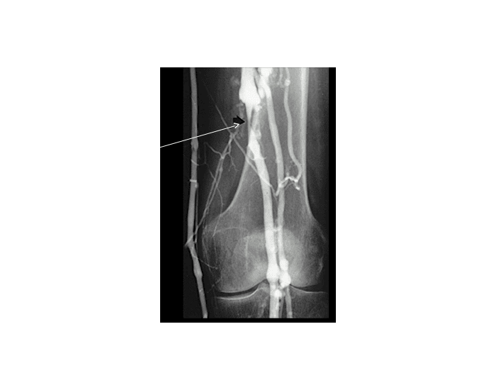 Lower Limb Venogram Quiz