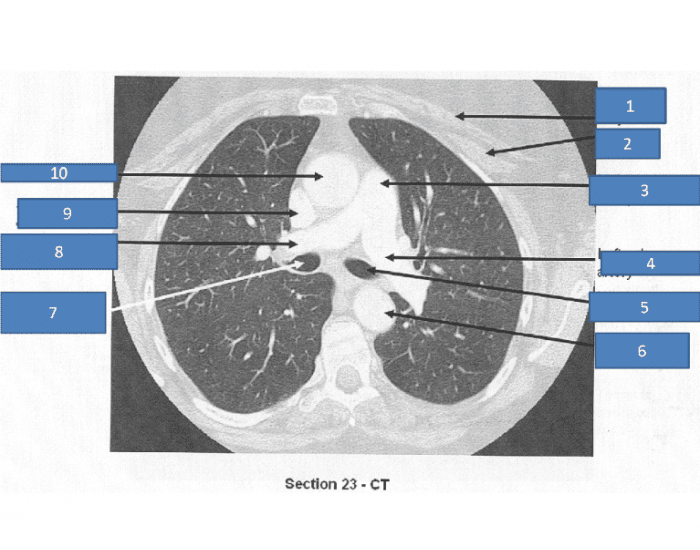 Thorax Based Label CT thorax label Quiz