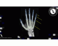 Ossos da mão por RX - 1