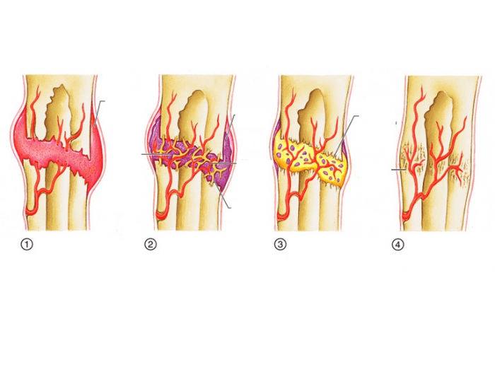 the-healing-of-a-bone-fracture-quiz