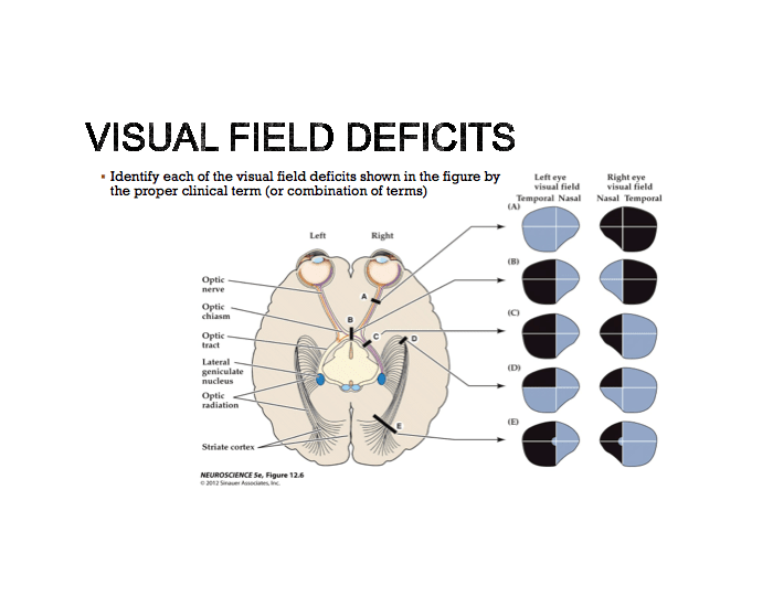 Visual Field Deficit Names visual field deficits — Printable Worksheet