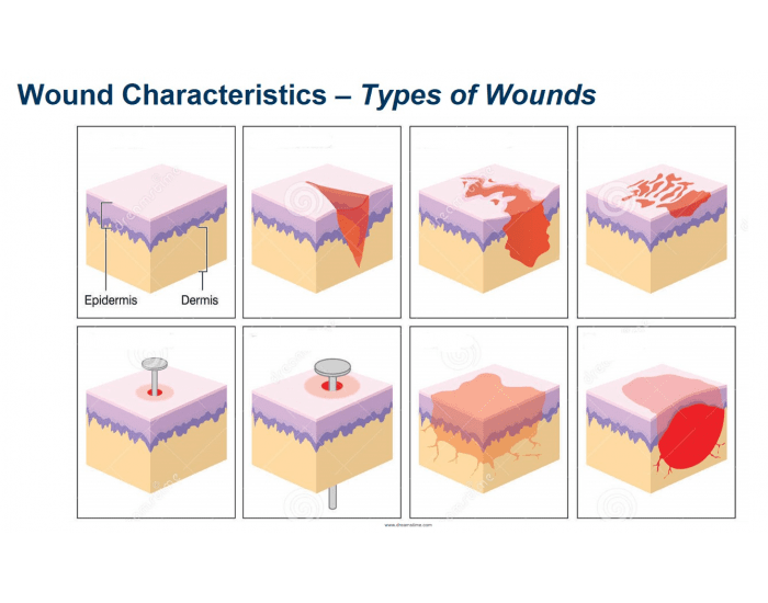 Types of Wounds Quiz