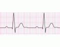 Label the EKG/ECG