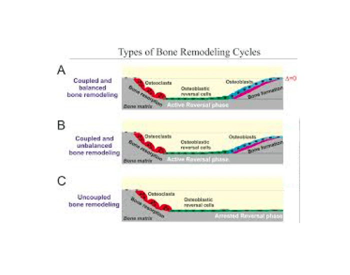 Bone Loss Areas Quiz
