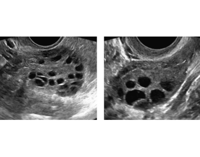 Polymo Cyst POLY CYSTS Quiz