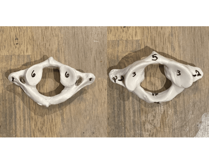 Atlas bone markings Quiz