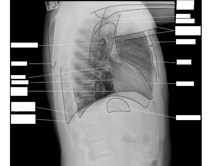 Labeling Radiograph Lateral Chest Xray Labeled