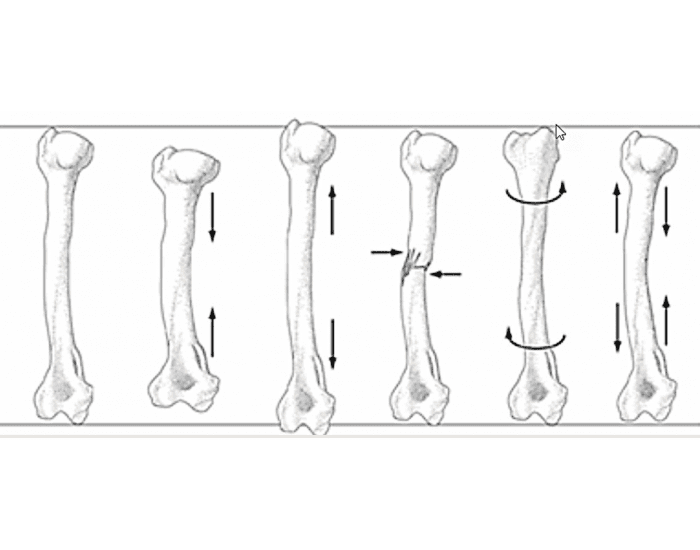 Forces commonly exerted on the bone Quiz