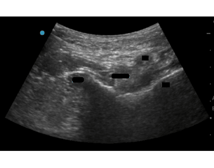 Peng Block Steps Pericapsular nerve group (PENG) block Quiz