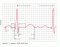 EKG: ID waves, segments, intervals