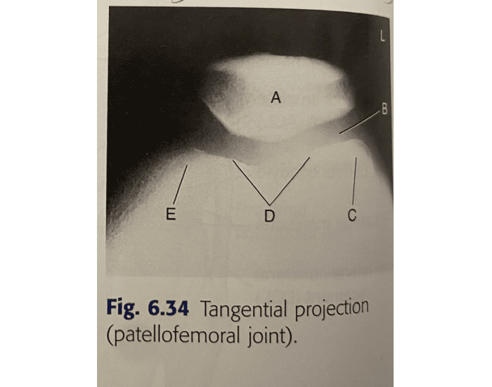 Tangential Projection Radiograph tangential projection (sunrise view) Quiz