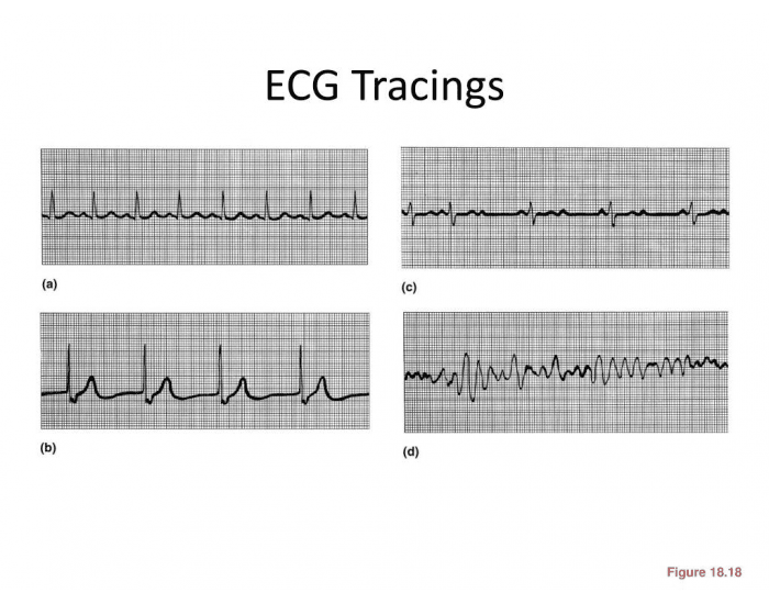 Ecg Tracings Printable Worksheet