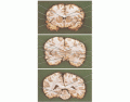 secciones coronales del cerebro