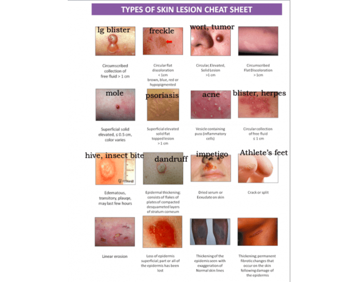 Types of Skin Lesions Quiz