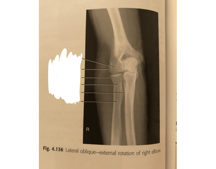 Elbow Extneral Rotation Lateral oblique (EXTERNAL ROTATION) of right elbow Quiz