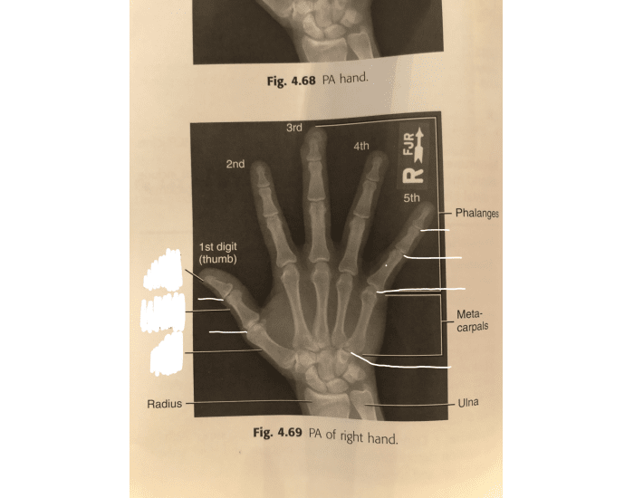 Right Pa Ranges Phalanges & Joints of PA right hand Quiz