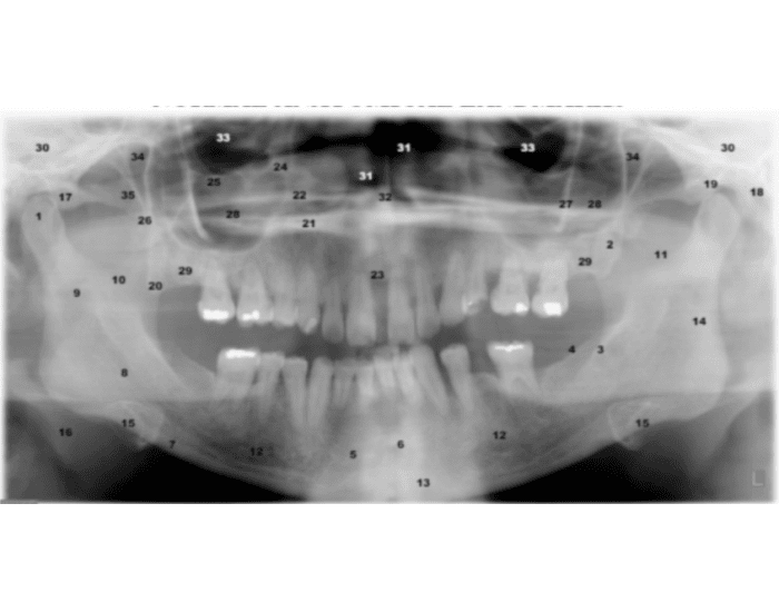 Panoramic Radiograph Normal Anatomical Landmarks — Printable Worksheet
