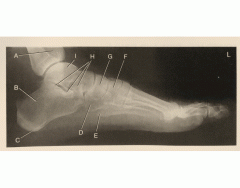 Lateral View - Left Foot