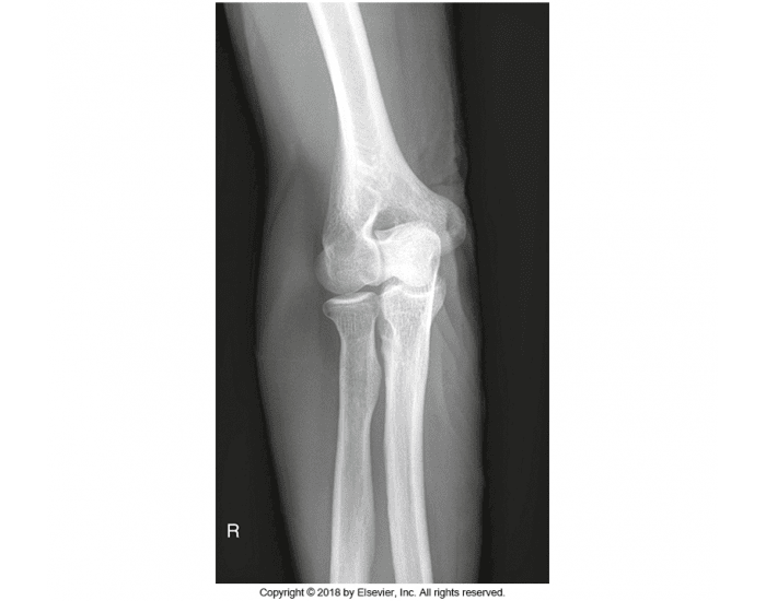 Elbow Extneral Rotation Lateral oblique external rotation of right elbow Quiz
