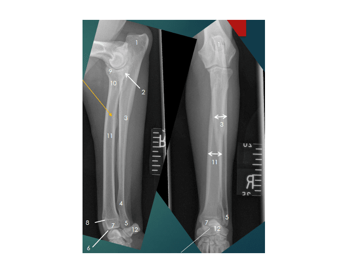 Radius/ulna radiographic anatomy Quiz