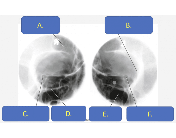 Reverse Rhese Method oblique projection (rhese method): optic foramina Quiz