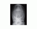 Radiografia do crânio - Anteroposterior axial