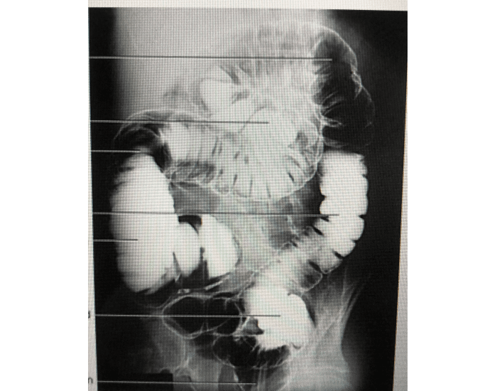 AP oblique large intestine, RPO double contrast Quiz