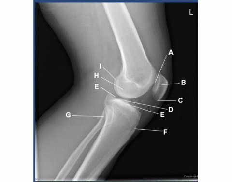 Frog Lateral Modified AP oblique- modified cleaves (frog leg) — Printable Worksheet