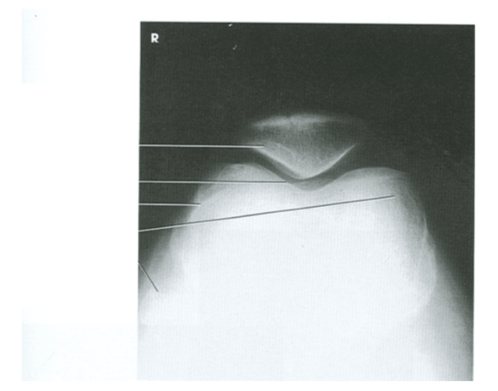 Settegast method Quiz