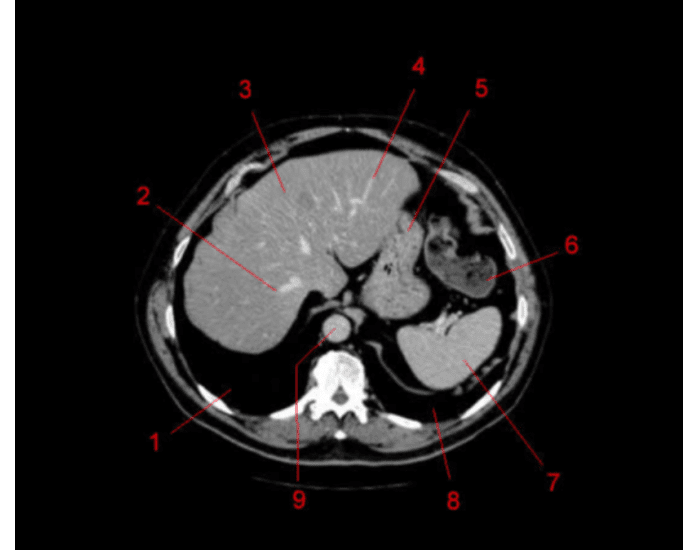 Ct Scan Worksheet.pdf CT scan abdomen — Printable Worksheet
