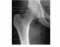 Hip Joint X-Ray