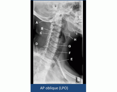 AP oblique rib (LPO) Quiz