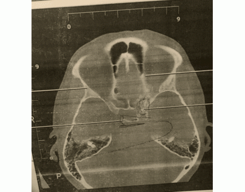 Tangential patella/ settegast method — Printable Worksheet