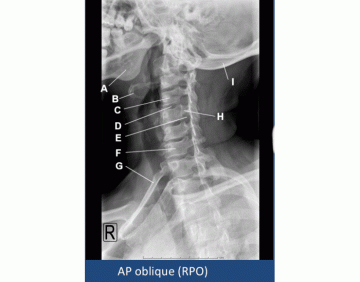 AP oblique rib (LPO) Quiz