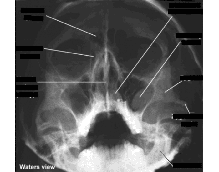 Walters View waters view of sinuses practical Quiz