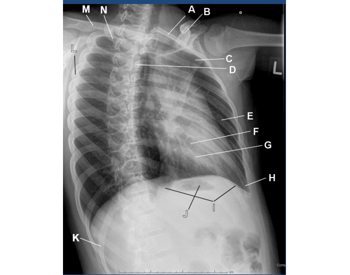 AP oblique rib (LPO) Quiz