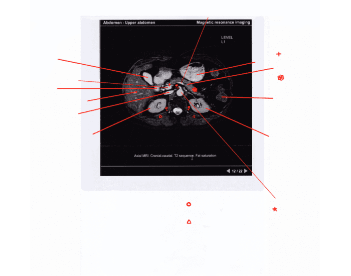 Mri Labelling Pages Labelling MRI of the Abdomen Quiz